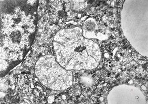 M,5y. | mitochondrial changes - Reye hepatocerebral syndrome M,5y. | mitochondrial changes - Reye hepatocerebral syndrome